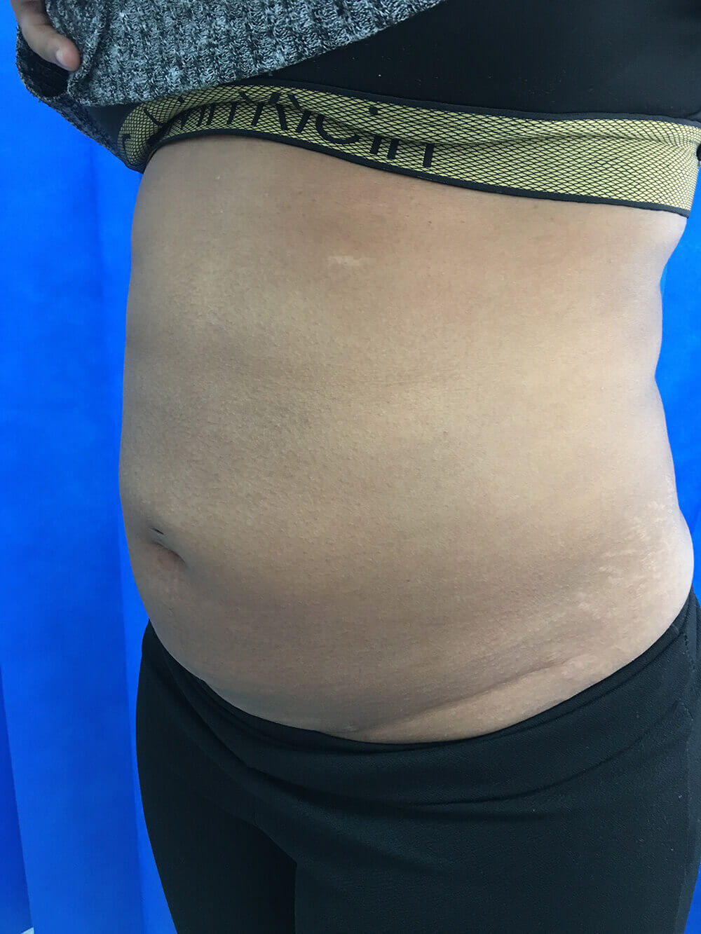 lipo-left-oblique-after