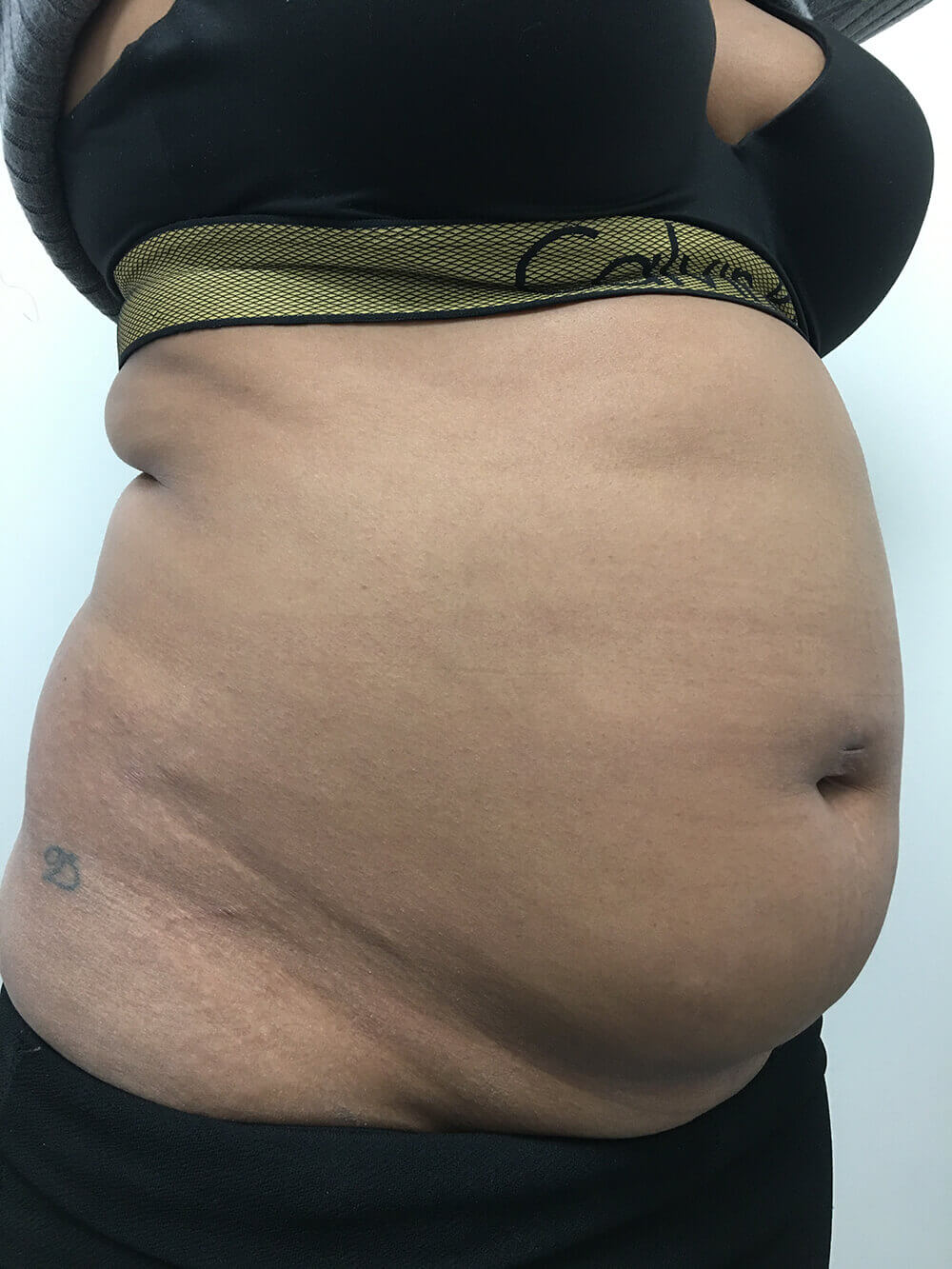 lipo-right-oblique-before