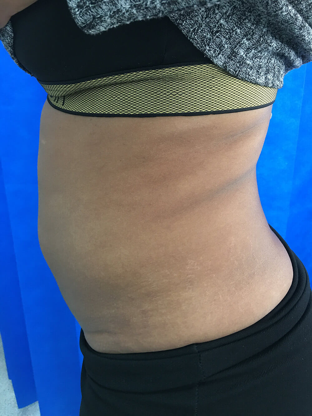 lipo-side-after